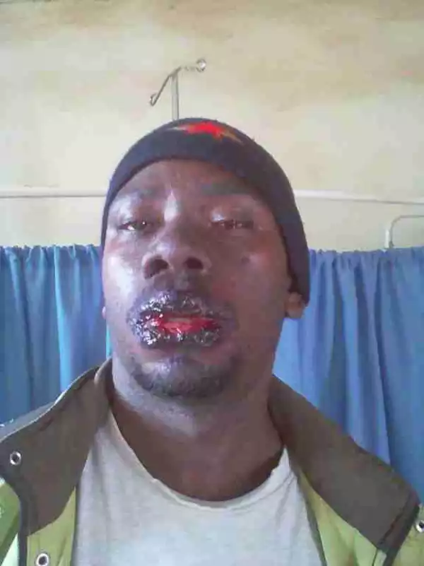 See What Malaria Drug Did To This Man (Disturbing Photos)